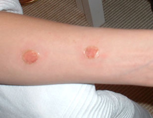 "Cigarette burn"-effect made with latex and greasepaint. The design was based on a reference model who actually had these injuries.